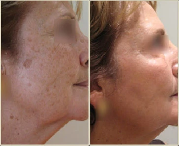 Terapia Combinada para Rejuvenecer  el rostro