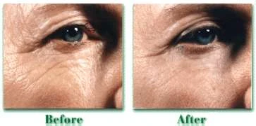 Envejecimiento cutáneo