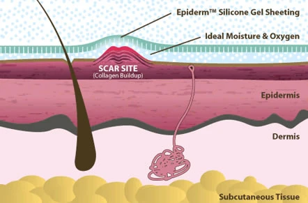 Esquema actuación biodermis cicatrizante