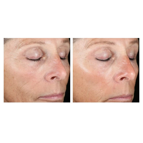 Deesse Pro Express mascarilla LED